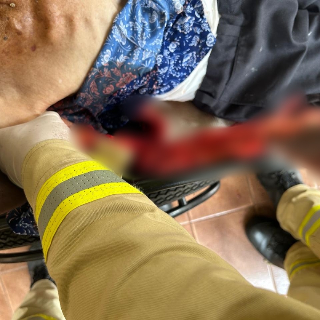 Idosa de 89 anos tem dedos arrancados e braço dilacerado após ser atacada por cão