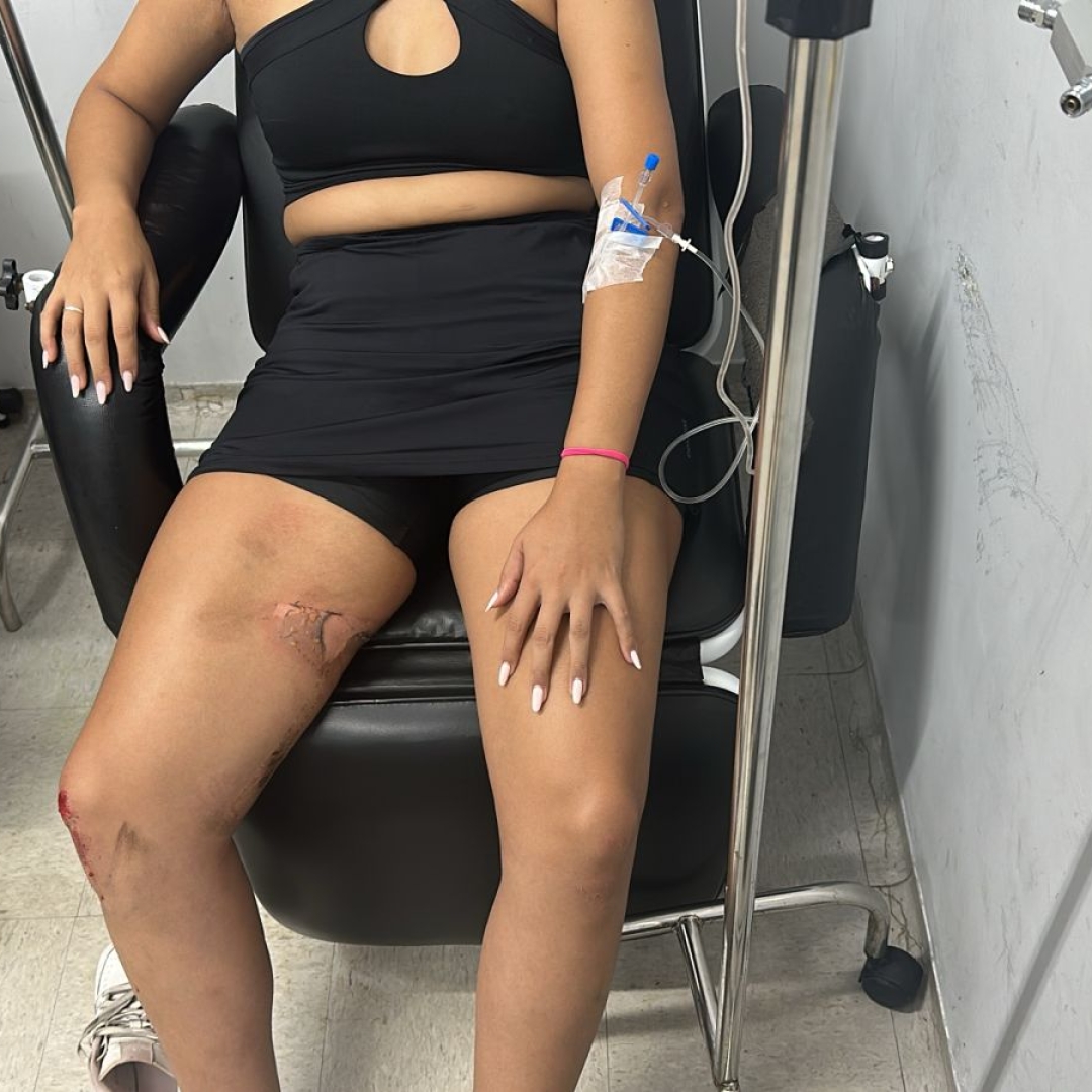 Mulher reage a assalto, cai com moto e sofre queimadura durante roubo em Maringá