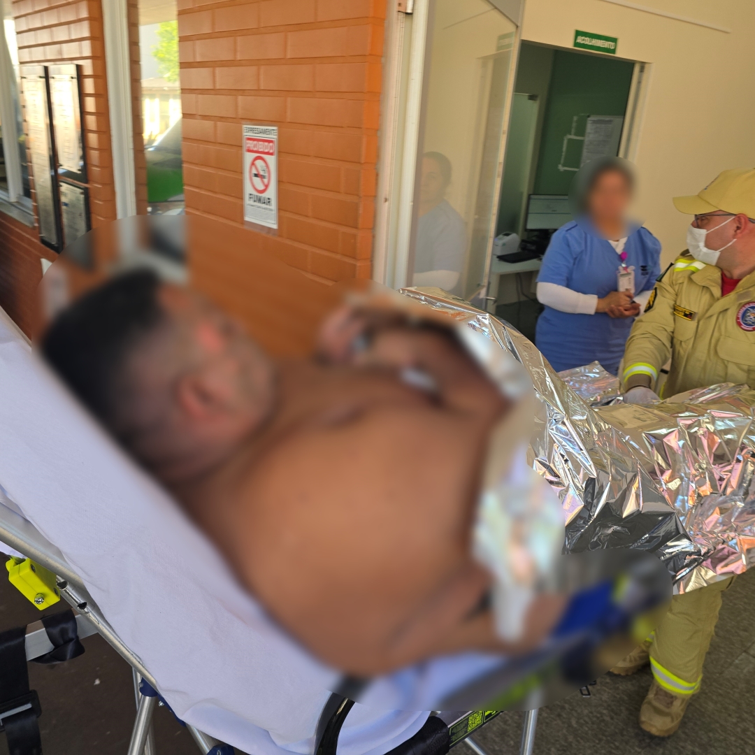 Homem que perdeu a perna em grave acidente sofre novas queimaduras após explosão de álcool em tacho em Sarandi