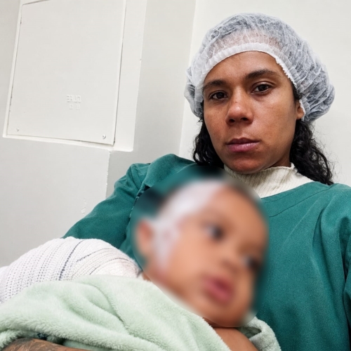 Criança vítima de queimaduras graves em creche municipal é submetida a novo procedimento no HU